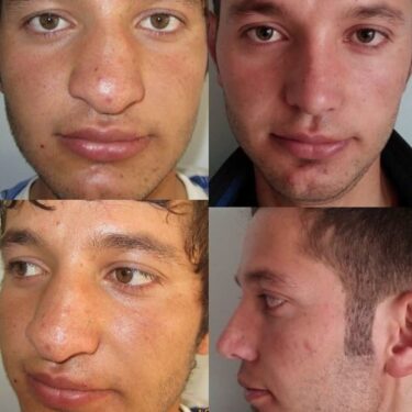 Ринопластика