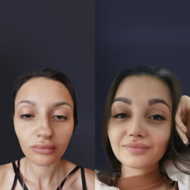 Ринопластика