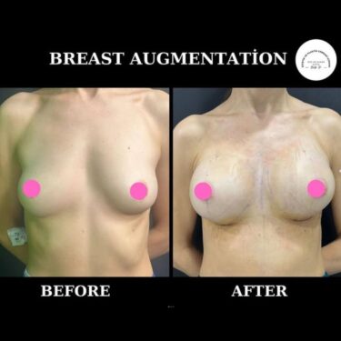 Увеличение груди