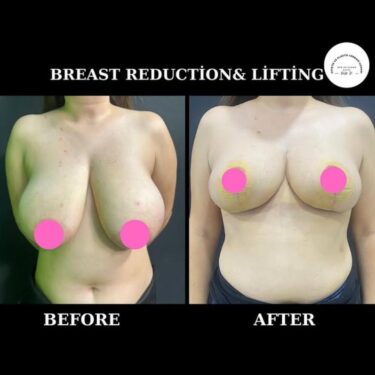 Breast Lift and Reduction