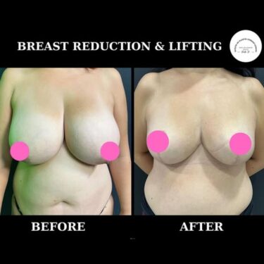 Breast Lift and Reduction