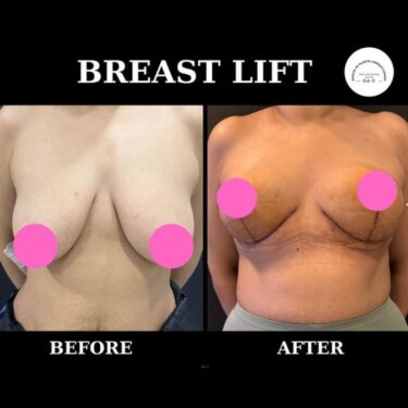 Breast Lift