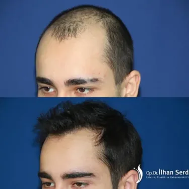 Пересадка волос