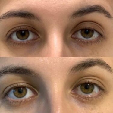 Eyelid surgery