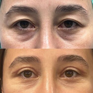 Eyelid surgery
