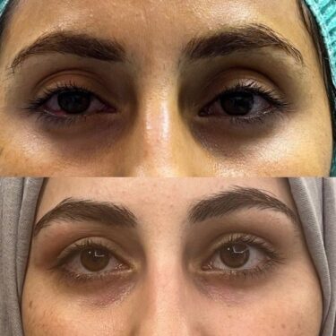 Eyelid surgery