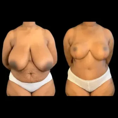 Breast Reduction