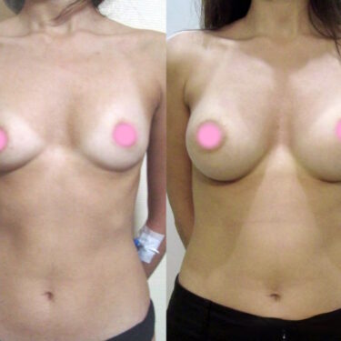 Увеличение груди