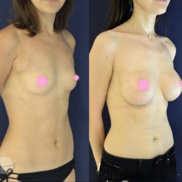 Увеличение груди