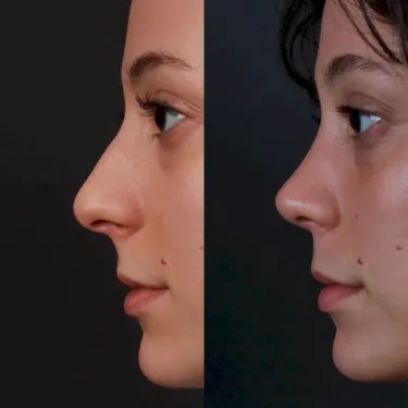 Rhinoplasty 
