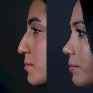 Rhinoplasty 