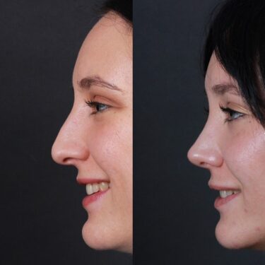 Rhinoplasty 