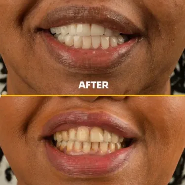 Отбеливание зубов