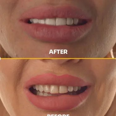 Отбеливание зубов