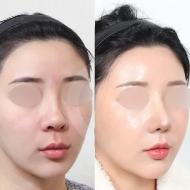 Rhinoplasty