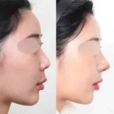 Rhinoplasty
