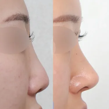 Rhinoplasty