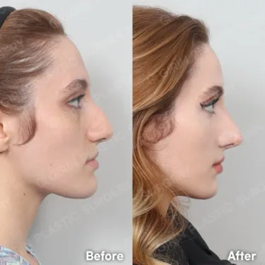 Rhinoplasty