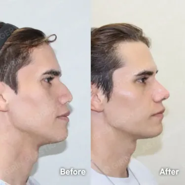 Rhinoplasty