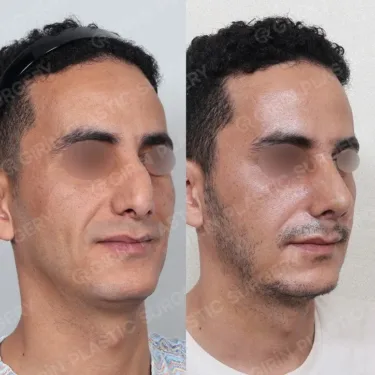 Rhinoplasty