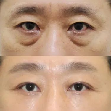 Нижняя блефаропластика