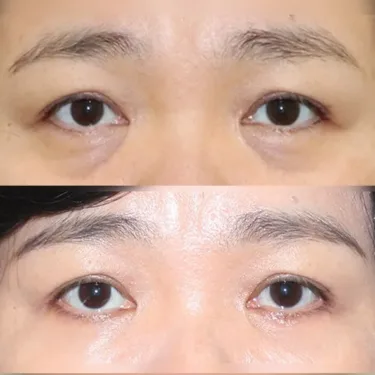 Нижняя блефаропластика