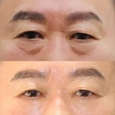 Нижняя блефаропластика