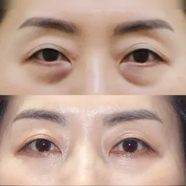 Нижняя блефаропластика