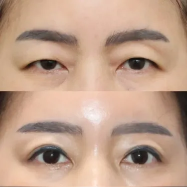 Верхняя блефаропластика