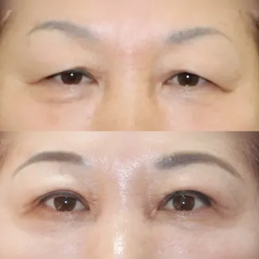 Верхняя блефаропластика