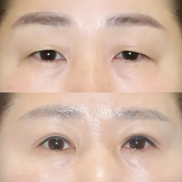 Верхняя блефаропластика