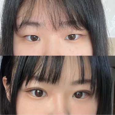 Eyelid surgery (blepharoplasty)
