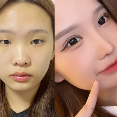 Eyelid surgery (blepharoplasty)