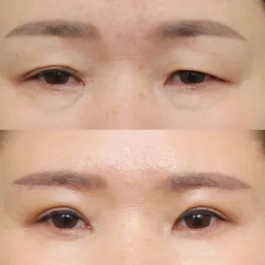 Eyelid surgery (blepharoplasty)