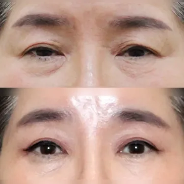 Eyelid surgery (blepharoplasty)