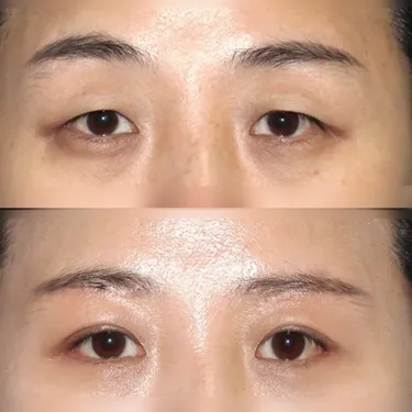 Eyelid surgery (blepharoplasty)
