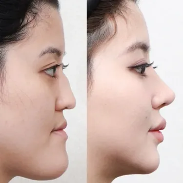 Rhinoplasty