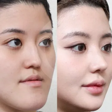 Rhinoplasty