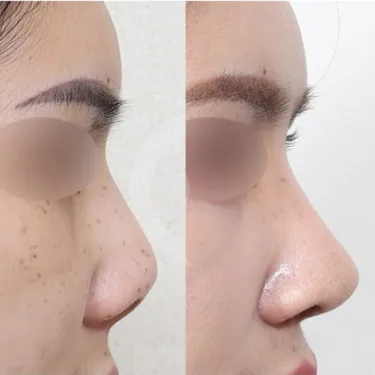 Nose surgery (rhinoplasty)
