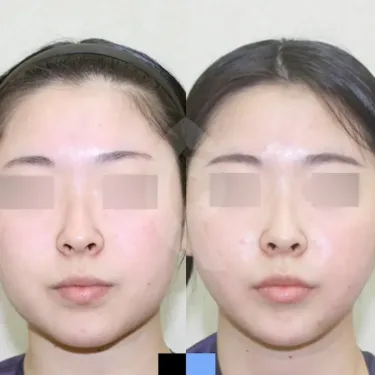 Facial liposuction