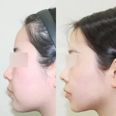 Facial liposuction