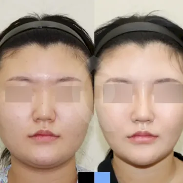 Facial liposuction