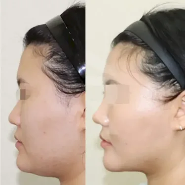 Facial liposuction