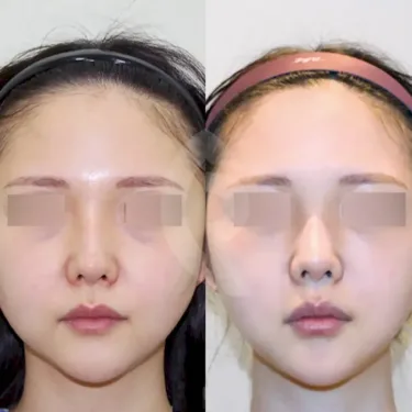 Facial liposuction