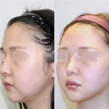 Facial liposuction