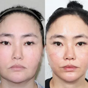 Facial liposuction