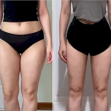 Thigh liposuction