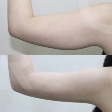 Arm liposuction