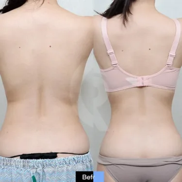 Circular liposuction