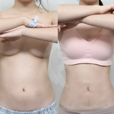 Circular liposuction